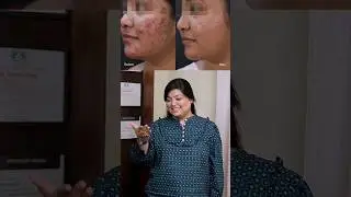 DMC-Berry Blast®️ & DMC-Acne Check Peel®️ for Acne Removal 