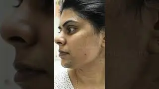 Laser Hair Reduction | Reduce unwanted hair growth | 