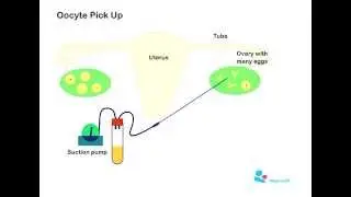 Oocyte Pick Up