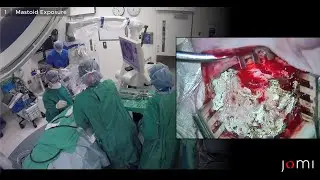 Mastoidectomy
