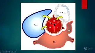 Sinus of valsalva aneurysm repair – Dr Ian Nicholson