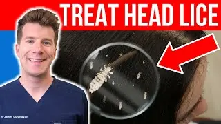 How to TREAT HEAD LICE AND NITS | Doctor's step-by-step guide