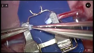 Microsurgical Technique for 1mm Vessel End to End Anastomosis by Yelena Akelina DVM