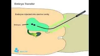 Embryo Transfer procedure