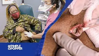 ELLE A UN KYSTE EN DESSOUS DU SEIN !