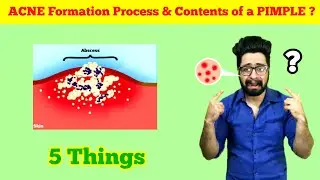 The Process of ACNE FORMATION & 5 Contents of a PIMPLE | #shorts #acne #pimples #comedones