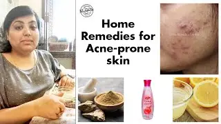 Best Home Remedy for Oily Acne Prone Skin | Dr. Nivedita Dadu