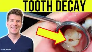 Doctor explains TOOTH DECAY (TOOTH CAVITY) - Causes, Symptoms and Treatment