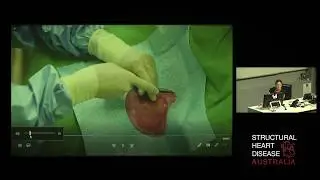 Live Case of Right Heart Catheterisation using Dynamic Exercise - Dr Katrina Adorini