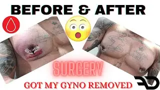 Before & After Gynecomastia Surgery | No More Gyno | Steroids & Sarms Cause Gyno MUST WATCH! GRAPHIC