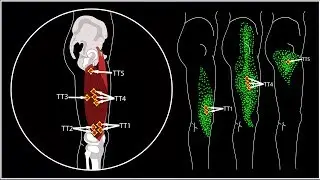 Hip and knee hurts. Trigger points of the square muscle of the thigh.
