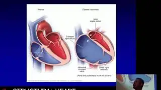 Ebstein’s anomaly of the tricuspid valve - Prof David Celermajer