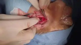 Evisceration with PMMA Implant