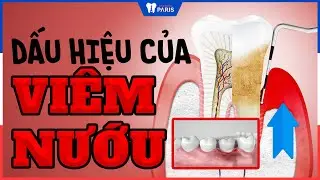 Cách nhận biết mình có bị viêm nướu răng hay không | Nha khoa Paris