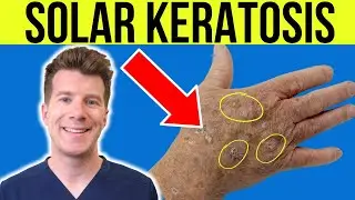 Doctor explains Actinic Solar Keratosis | Sun damaged skin - causes, symptoms and treatment