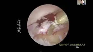 Preliminary Application of OTO'VIEW Technique in Endoscopic Ear Surgery