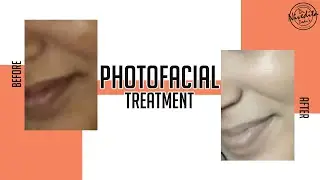Photofacial का इलाज | Photofacial Treatment | Before-After | Dr. Nivedita Dadu Dermatology Clinic
