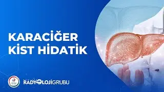 Karaciğer Kist Hidatik I Radyoloji Grubu