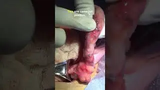 Open Proctocolectomy for Hirschsprung's Disease #hospital #doctor #surgeon #learn #medicine #watch
