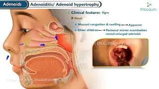 Adenoid Hyperthropy 🦠 : ENT Lectures