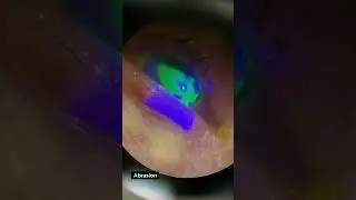 Corneal Staining with Fluorescein #ophthalmology #eye #meded #surgeon #medical #hospital #surgery