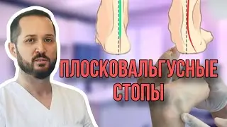 Как выглядит плосковальгусная стопа, 3 причины и лечение