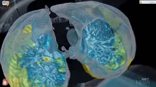 3D imaging shows how quickly COVID-19 can attack a healthy persons lungs