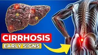 Early Liver Cirrhosis Symptoms: Spotting Liver Damage and Disease Signs