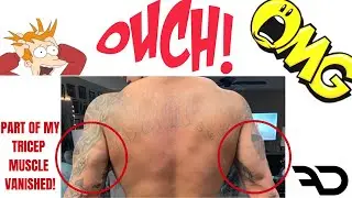 Part of my Tricep Muscle Vanished! | HELP! | Tricep Tear or Is It? | Medial Tricep Head Missing