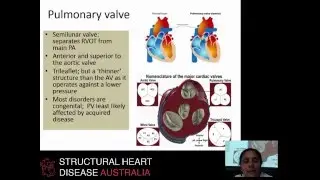 Pulmonary valve pathology and echocardiographic assessment - Dr Liza Thomas