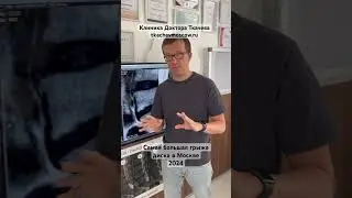 Грыжа позвоночника. Самая большая в Москве. Пример лечения без операции.