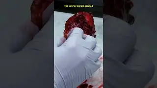 Analyzing Sarcoma Margins in the Frozen Lab #medicine #learn #frozen #hospital #medical #doctor #OR