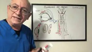 Síndrome de Horner. Explicacion Neurofisiologica. Niveles de afectacion.  Miosis o  Midriasis