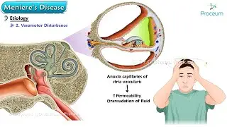 Meniere's Disease 🌀 : ENT Lectures