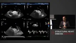 Detection of Left Atrial Thrombus - A/Prof Phillip Mottram