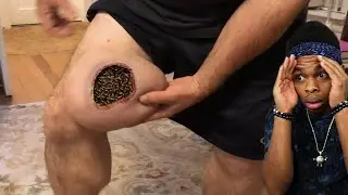 these ticks got stuck in his leg..