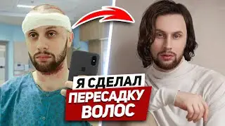 ПРОВЕРИЛ НА СЕБЕ ПЕРЕСАДКУ ВОЛОС