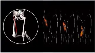 Pain in the hip and knee on the inner surface 🔴 Musculus sartorius