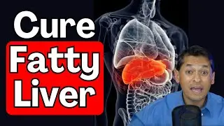 How to Cure Fatty Liver! | Lifestyle Changes to Help Reverse NAFLD