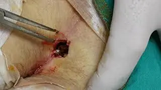 Pilonidal kist apseli     Pilonidal cyst with abcess