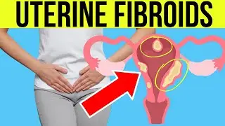 Doctor explains UTERINE FIBROIDS | Symptoms, Causes, Treatment