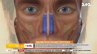 Викривлення носової перетинки: як розпізнати та чи завжди потрібна операція