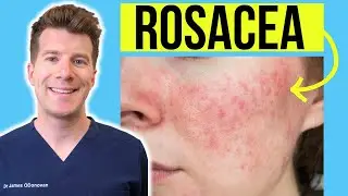 Doctor explains ROSACEA | Skin Condition - Causes, Treatment and more!