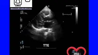 Cardiac Cysts