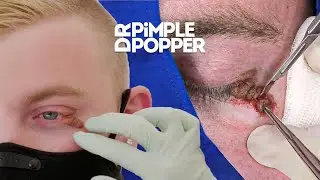 IL A UNE TACHE DE NAISSANCE SUR L'OEIL