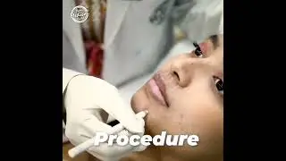 Lip fillers procedure | lip fillers shorts | 