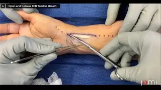 Distal Radius Open Reduction and Internal Fixation