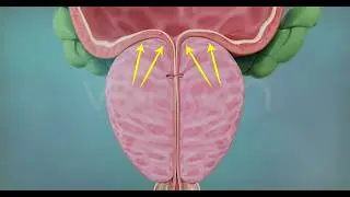 CRYOABLATION TREATMENT FOR BENIGN PROSTATIC HYPERPLASIA (BPH)