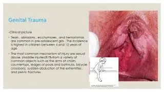 Considerations in paediatric gynaecology