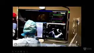 Live case of balloon mitral valvuloplasty – Prof Brian Bailey